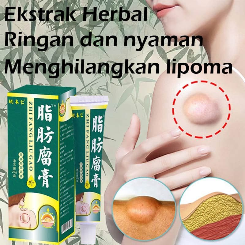 Review Obat Lipoma: Ampuhkah Hilangkan Benjolan?